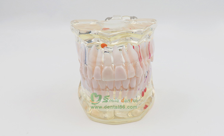 TM-C2 Pathology Model with a tooth missing